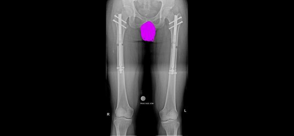 DJCyborg | Dr. Birkholtz | Precice 2.2 Femurs | June 2023