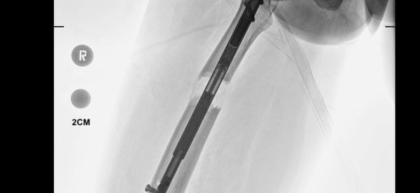 DJCyborg | Dr. Birkholtz | Precice 2.2 Femurs | June 2023