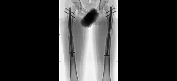 DJCyborg | Dr. Birkholtz | Precice 2.2 Femurs | June 2023